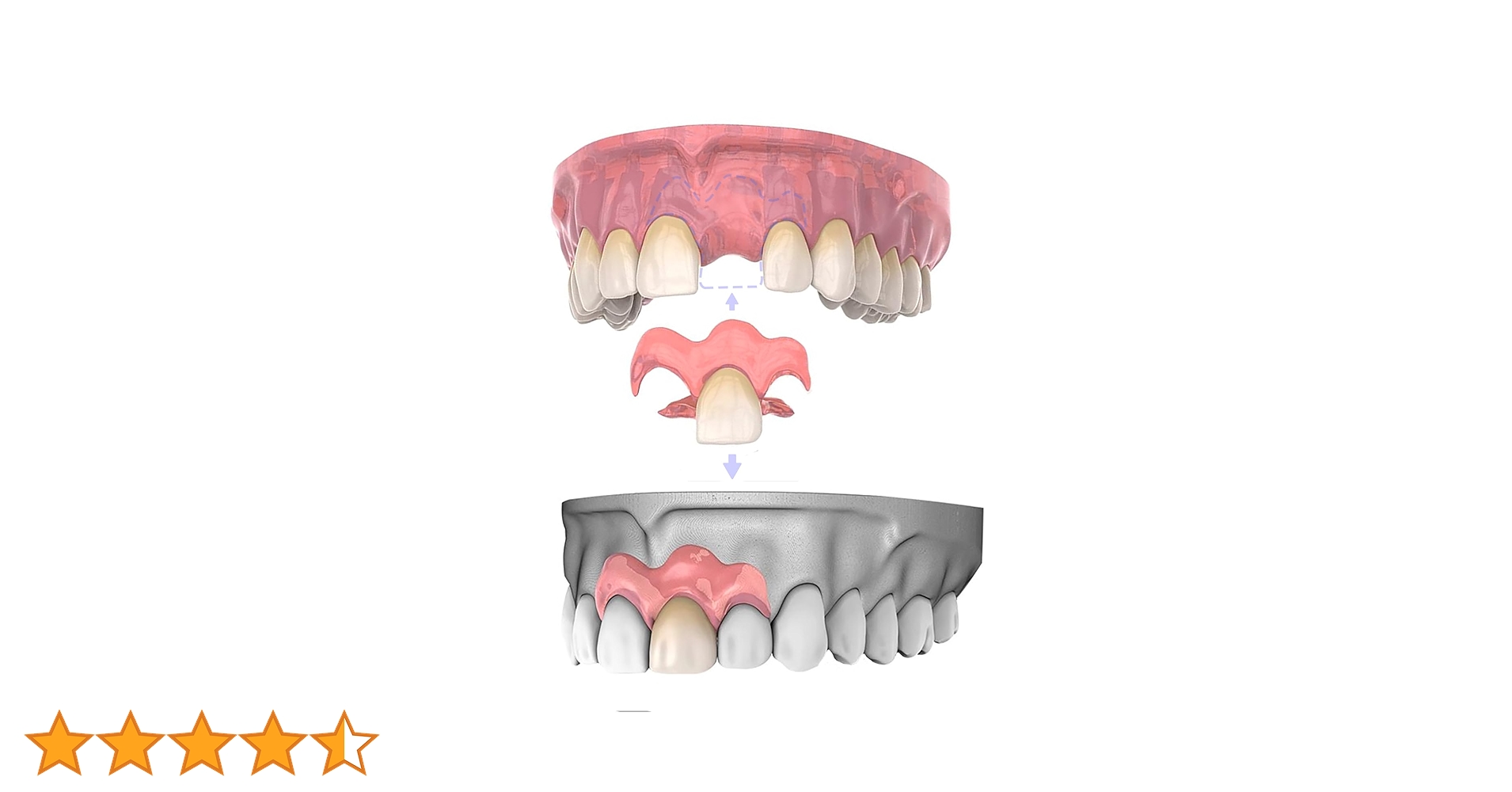 1本 カスタム 入れ歯 部分 取り外し可能 Dentellea 義歯 携帯便利 Amazon.co.jp: 1本 カスタム 入れ歯 部分 取り外し可能